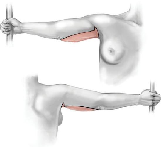 brachioplastica - lifting braccia