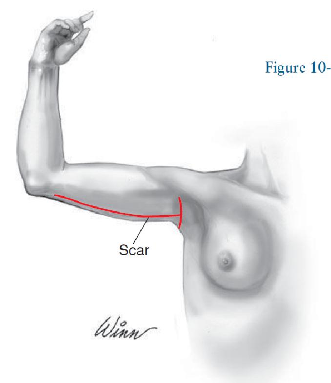 Brachioplasty of the arms