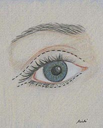 blefaroplastica - 3 - Viso