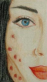 Esiti da acne - Dermoabrasione