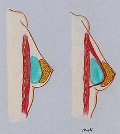 mastoplastica-additiva-3 - Mastoplastica