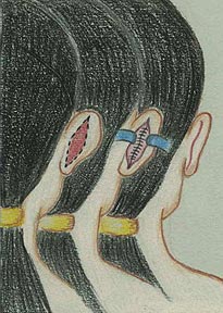 otoplastica-2 - Orecchie