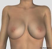 Additive-large-post - Breastplasty