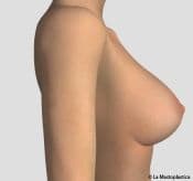 additive-large-lateral-POST - Breastplasty