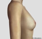 additive% 20media% 20flateral% 20PRE - Mastoplasty