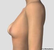 lateral-asymmetry-PRE - Breastplasty