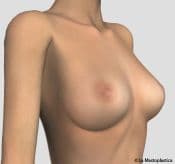 Detail - Frontal mastopexy