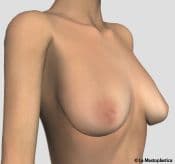 Frontal Image - Mastopexy