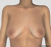 Frontal Image - Mastopexy