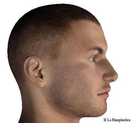 Lateral - post - rhinoplasty