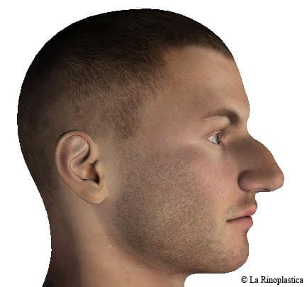 Lateral - right - Rhinoplasty