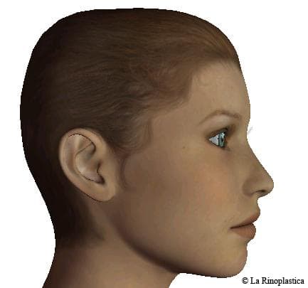 Lateral - post - rhinoplasty