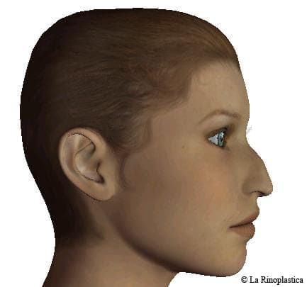 Lateral - right - Rhinoplasty