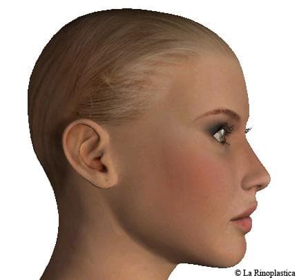 Lateral - post - rhinoplasty