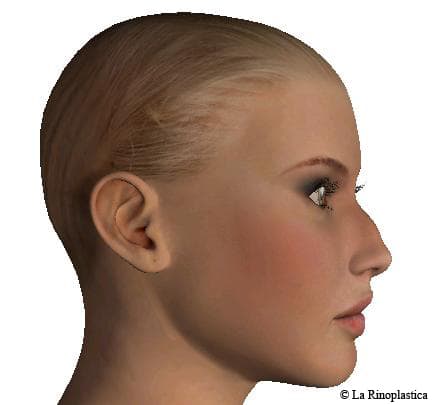 Lateral - right - Rhinoplasty