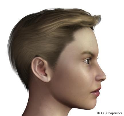 lateral-POST- Rhinoplasty