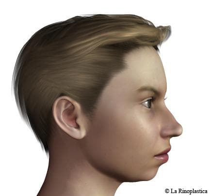 lateral-pre - Rhinoplasty